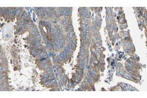 ABIN6274763 at 1/100 staining Human cervical cancer tissue by IHC-P. (AZI1 抗体  (C-Term))