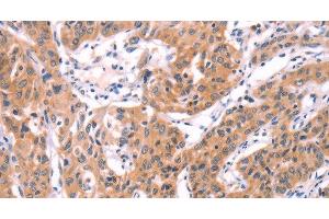 Immunohistochemistry of paraffin-embedded Human lung cancer using SERPINA5 Polyclonal Antibody at dilution of 1:40 (SERPINA5 抗体)