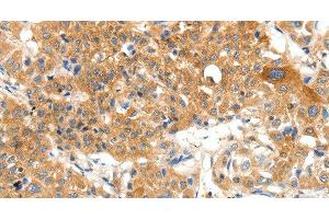 Immunohistochemistry of paraffin-embedded Human lung cancer using PLAT Polyclonal Antibody at dilution of 1:50 (PLAT 抗体)
