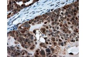 Immunohistochemical staining of paraffin-embedded Adenocarcinoma of breast tissue using anti-SRR mouse monoclonal antibody. (SRR 抗体)
