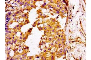 IHC image of ABIN7175537 diluted at 1:100 and staining in paraffin-embedded human breast cancer performed on a Leica BondTM system. (GGCX 抗体  (AA 383-526))