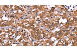 Immunohistochemistry of paraffin-embedded Human thyroid cancer tissue using AMER1 Polyclonal Antibody at dilution 1:40 (WTX 抗体)