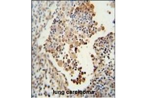 CADM1 antibody (N-term) (ABIN654660 and ABIN2844356) immunohistochemistry analysis in formalin fixed and paraffin embedded human lung carcinoma followed by peroxidase conjugation of the secondary antibody and DAB staining.
