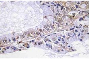 Immunohistochemistry (IHC) analyzes of p-Cofilin in paraffin-embedded human lung carcinoma tissue. (Cofilin 抗体  (pSer3))
