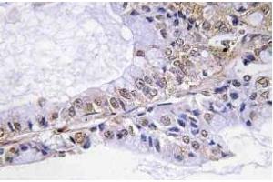 Immunohistochemistry (IHC) analyzes of p-Cofilin in paraffin-embedded human lung carcinoma tissue. (Cofilin 抗体  (pSer3))