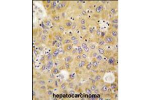 Formalin-fixed and paraffin-embedded human hepatocarcinoma tissue reacted with AARS antibody , which was peroxidase-conjugated to the secondary antibody, followed by DAB staining. (AARS2 抗体  (N-Term))