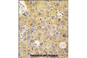 Formalin-fixed and paraffin-embedded human hepatocarcinoma tissue reacted with AARS antibody , which was peroxidase-conjugated to the secondary antibody, followed by DAB staining.