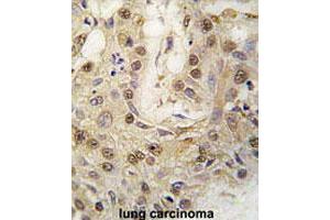 Formalin-fixed and paraffin-embedded human lung carcinomareacted with PRKG2 polyclonal antibody , which was peroxidase-conjugated to the secondary antibody, followed by AEC staining. (PRKG2 抗体  (C-Term))