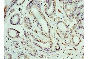 Immunohistochemistry of paraffin-embedded human breast cancer using ABIN7164185 at dilution of 1:100 (BCAS2 抗体  (AA 1-225))