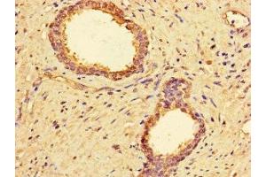 Immunohistochemistry of paraffin-embedded human prostate cancer using ABIN7142866 at dilution of 1:100 (MMP2 抗体  (AA 445-660))