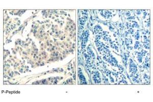 Immunohistochemical analysis of paraffin-embedded human breast carcinoma tissue using ABL1/ABL2 (phospho Y393/429) polyclonal antibody . (ABL1 抗体  (pTyr393, pTyr429))
