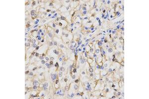 Immunohistochemistry of paraffin-embedded human kidney cancer using PPP2R4 Antibody. (PPP2R4 抗体)