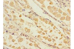 Immunohistochemistry of paraffin-embedded human gastric cancer using ABIN7168232 at dilution of 1:100 (RCHY1 抗体  (AA 1-261))