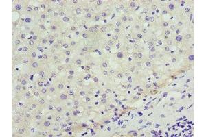 Immunohistochemistry of paraffin-embedded human liver cancer using ABIN7151358 at dilution of 1:100 (ENOX1 抗体  (AA 101-340))