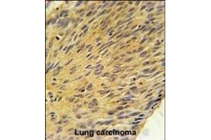 MURC Antibody (N-term) (ABIN651833 and ABIN2840416) immunohistochemistry analysis in formalin fixed and paraffin embedded human lung carcinoma followed by peroxidase conjugation of the secondary antibody and DAB staining. (MURC 抗体  (N-Term))