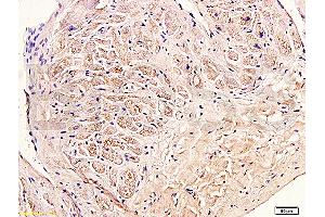 Formalin-fixed and paraffin embedded human myocardium tissue labeled with Anti-Collagen III Polyclonal Antibody (ABIN669981), Unconjugated at 1:400, followed by conjugation to the secondary antibody and DAB staining (COL3 抗体  (AA 1301-1400))