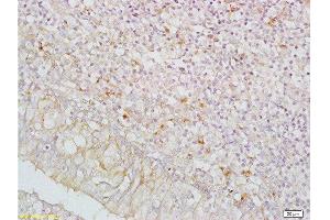 Formalin-fixed and paraffin embedded human nasopharyngeal carcinoma labeled with Anti-IGFBP5/IBP5 Polyclonal Antibody , Unconjugated at 1:200, followed by conjugation to the secondary antibody and DAB staining (IGFBP5 抗体  (AA 101-200))