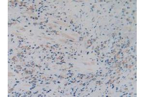IHC-P analysis of Human Prostate Gland Cancer Tissue, with DAB staining. (C1QBP 抗体  (AA 76-282))