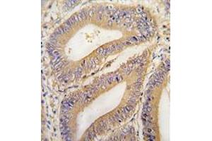 Formalin-fixed and paraffin-embedded human colon carcinoma tissue reacted with PHB2 Antibody (N-term) , which was peroxidase-conjugated to the secondary antibody, followed by DAB staining. (Prohibitin 2 抗体  (N-Term))