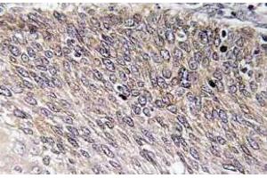 Immunohistochemistry (IHC) analyzes of p-VASP antibody in paraffin-embedded human cervix carcinoma tissue. (VASP 抗体  (pSer238))