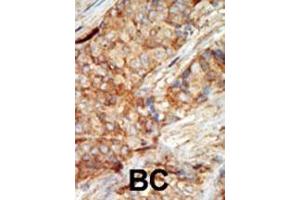 Formalin-fixed and paraffin-embedded human cancer tissue reacted with the primary antibody, which was peroxidase-conjugated to the secondary antibody, followed by AEC staining. (GCK 抗体  (N-Term))