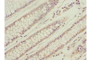 Immunohistochemistry of paraffin-embedded human colon cancer using ABIN7166319 at dilution of 1:100 (WNT9A 抗体  (AA 206-365))