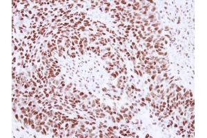 IHC-P Image Immunohistochemical analysis of paraffin-embedded human breast cancer, using SNRPA, antibody at 1:250 dilution.