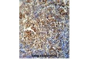 F1 antibody (Center) (ABIN654163 and ABIN2844027) immunohistochemistry analysis in forlin fixed and paraffin embedded hun lung carcino followed by peroxidase conjugation of the secondary antibody and DAB staining. (MAF1 抗体  (AA 90-117))