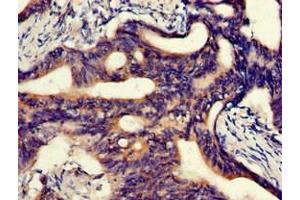 Immunohistochemistry of paraffin-embedded human colon cancer using ABIN7144881 at dilution of 1:100 (ABCA5 抗体  (AA 1230-1355))