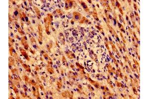 Immunohistochemistry of paraffin-embedded human liver cancer using ABIN7162762 at dilution of 1:100 (MTRF1 抗体  (AA 285-433))