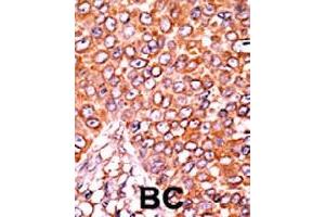 Formalin-fixed and paraffin-embedded human cancer tissue reacted with CDKN1B (phospho T157) polyclonal antibody  which was peroxidase-conjugated to the secondary antibody followed by AEC staining. (CDKN1B 抗体  (pThr157))