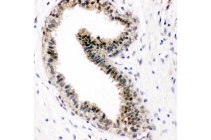 Anti-VCP antibody, IHC(P) IHC(P): Human Mammary Cancer Tissue (VCP 抗体  (C-Term))