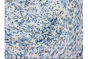 Immunohistochemical staining of paraffin-embedded Carcinoma of thyroid tissue using anti-STK39mouse monoclonal antibody. (STK39 抗体)