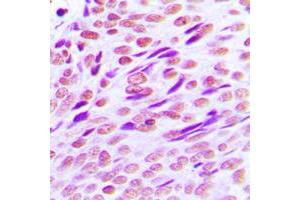 Immunohistochemical analysis of CTBP2 staining in human breast cancer formalin fixed paraffin embedded tissue section. (CTBP2 抗体  (C-Term))