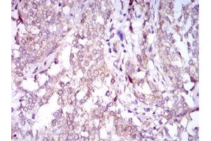 Immunohistochemical analysis of paraffin-embedded bladder cancer tissues using SQSTM1 mouse mAb with DAB staining.