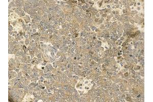 ABIN6259273 and ABIN6273655 at 1/100 staining human melanoma by IHC-P. (FIL1h 抗体  (C-Term))