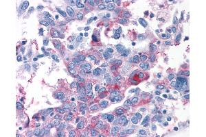 Anti-T1R1 / TAS1R1 antibody IHC of human Ovary, Carcinoma. (TAS1R1 抗体  (N-Term))