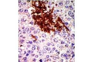 Formalin-fixed and paraffin-embedded human cancer tissue (breast carcinoma) reacted with the primary antibody, which was peroxidase-conjugated to the secondary antibody, followed by DAB staining. (RIOK1 抗体  (N-Term))