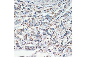 Immunohistochemistry of paraffin-embedded human breast cancer using APC antibody (ABIN1678689, ABIN1678690, ABIN5664154 and ABIN6219837) at dilution of 1:200 (40x lens). (APC 抗体  (AA 2544-2843))