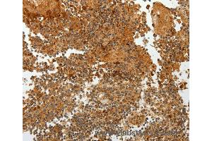 Immunohistochemistry of Human ovarian cancer using TFF2 Polyclonal Antibody at dilution of 1:40 (Trefoil Factor 2 抗体)