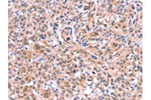 The image on the left is immunohistochemistry of paraffin-embedded Human esophagus cancer tissue using ABIN7128670(BMPR2 Antibody) at dilution 1/35, on the right is treated with fusion protein. (BMPR2 抗体)