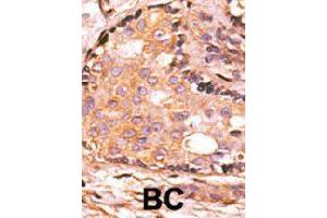 Formalin-fixed and paraffin-embedded human breast cancer tissue reacted with DUSP4 polyclonal antibody  , which was peroxidase-conjugated to the secondary antibody, followed by AEC staining. (DUSP4 抗体  (C-Term))
