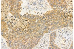 ABIN6260209 and ABIN6272937 at 1/100 staining Human lung cancer by IHC-P.