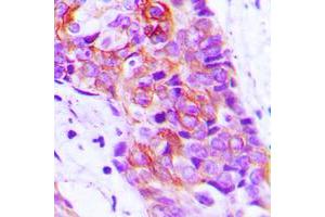 Immunohistochemical analysis of Adenylate Cyclase 9 staining in human breast cancer formalin fixed paraffin embedded tissue section. (ADCY9 抗体  (N-Term))
