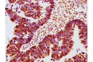 IHC image of ABIN7127703 diluted at 1:100 and staining in paraffin-embedded human ovarian cancer performed on a Leica BondTM system. (Recombinant JAK2 抗体  (pTyr1007, pTyr1008))