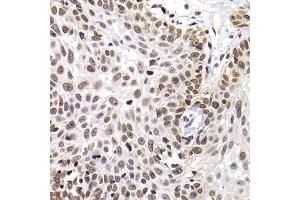 Immunohistochemistry of paraffin-embedded human well-differentiated squamous skin carcinoma using PHIP antibody (ABIN5974339) at dilution of 1/100 (40x lens). (PHIP 抗体)