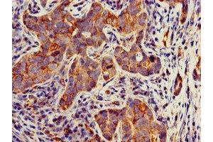 Immunohistochemistry of paraffin-embedded human pancreatic cancer using ABIN7171684 at dilution of 1:100 (TECPR2 抗体  (AA 516-783))