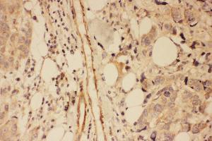Anti-PSD95 antibody, IHC(P) IHC(P): Human Mammary Cancer Tissue (DLG4 抗体  (C-Term))