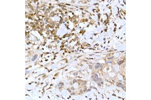 Immunohistochemistry of paraffin-embedded human breast cancer using TFEB Rabbit pAb (ABIN6128819, ABIN6149043, ABIN6149045 and ABIN6223149) at dilution of 1:100 (40x lens). (TFEB 抗体)