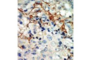 Formalin-fixed and paraffin-embedded human cancer tissue reacted with the primary antibody, which was peroxidase-conjugated to the secondary antibody, followed by AEC staining. (EPH Receptor A3 抗体  (N-Term))